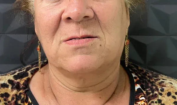 Resultado de implante dentário na Odontologia Agrega — antes e depois 1