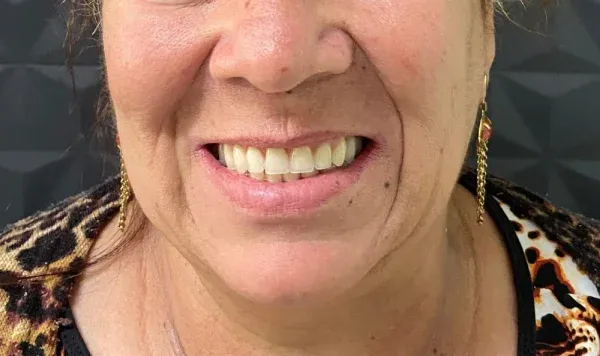 Resultado de implante dentário na Odontologia Agrega — antes e depois 2