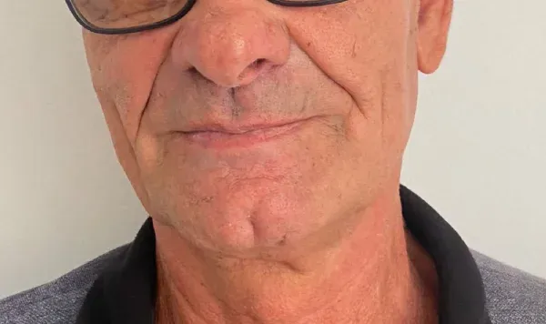 Resultado de implante dentário na Odontologia Agrega — antes e depois 3