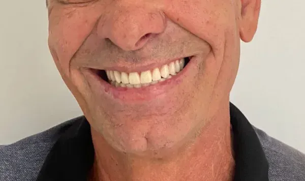 Resultado de implante dentário na Odontologia Agrega — antes e depois 4