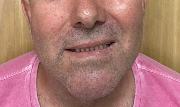 Resultado de implante dentário na Odontologia Agrega — antes e depois 5