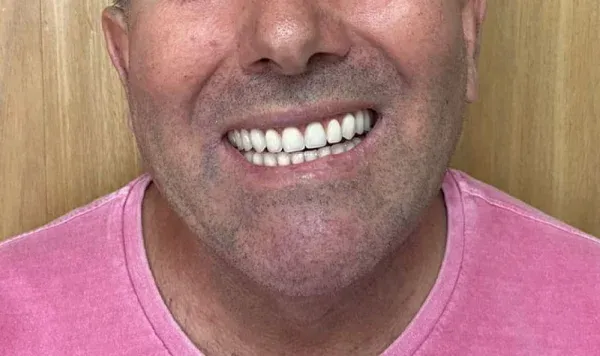 Resultado de implante dentário na Odontologia Agrega — antes e depois 6