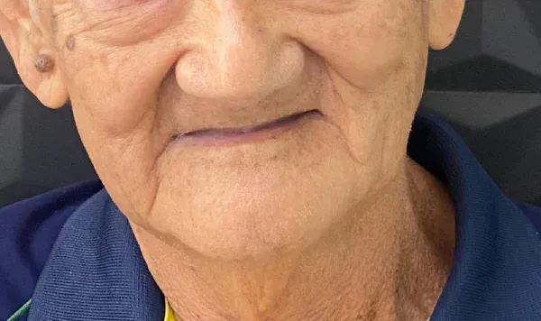 Resultado de implante dentário na Odontologia Agrega — antes e depois 7