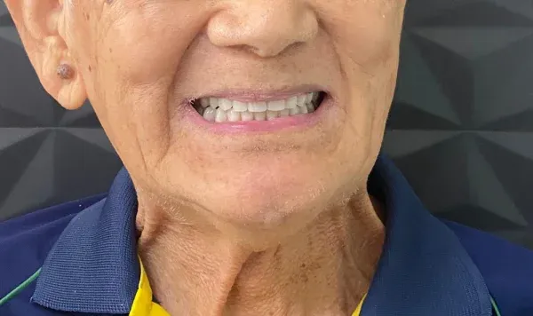 Resultado de implante dentário na Odontologia Agrega — antes e depois 8