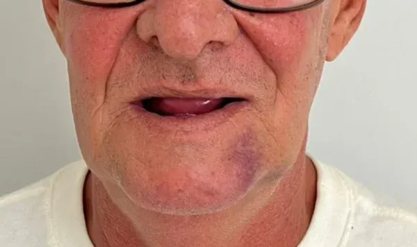 Resultado de implante dentário na Odontologia Agrega — antes e depois 9