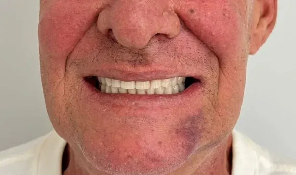 Resultado de implante dentário na Odontologia Agrega — antes e depois 10